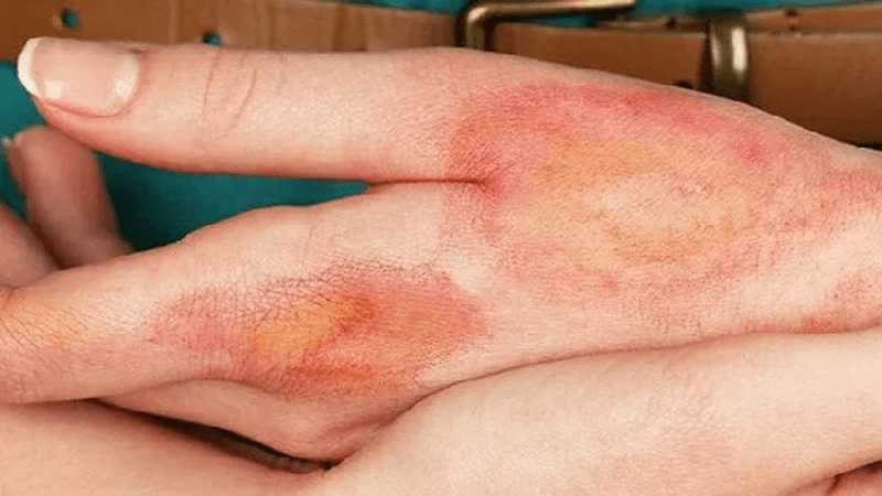 Nằm mơ bị bỏng do lửa